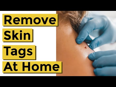 how to use compound w on skin tags