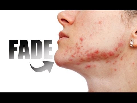 how to make acne redness go away