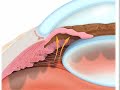 Laser for Narrow Angle Glaucoma - Part 1 from The Eye Clinic of Florida
