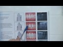 Teeth Whitening : Gingivitis Symptoms