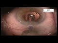 Tecnis monofocal y multifocal Tecnis monofocal y multifocal