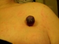 warning gross !!!!!!
please do not follow my example , this should be done by a doctor!!!!!
i have a phobia of needles , thats why i chose to do this myself.
this is a skin tag thats been on me since i was little and it kept getting bigger, at this point its been froze and tied off, and was annoying the crap out of me, so i decided to cut it off.
and i did !