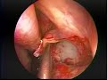Endoscopic Management of a Type 2 Hypoplastic Maxillary Sinu