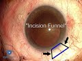 Scleral Tunnel Phaco basic techniques
