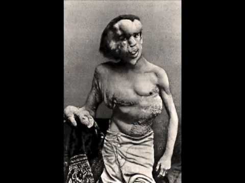 'Reviving the Elephant Man' (Forensic Reconstruction)