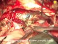 Neurosurgery video basilar bifurcation aneurysm clipping