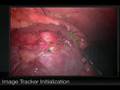 JHU Kidney Stone Overlay Project