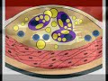 Atherosclerosis Atherosclerosis