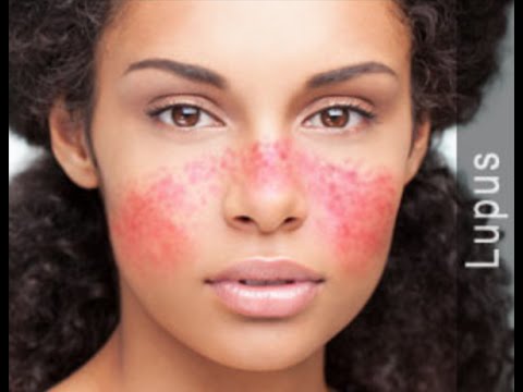 Systemic Lupus Erythematosus