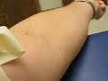 5 Hour Glucose Tolerance Test (Part 2 of 3)