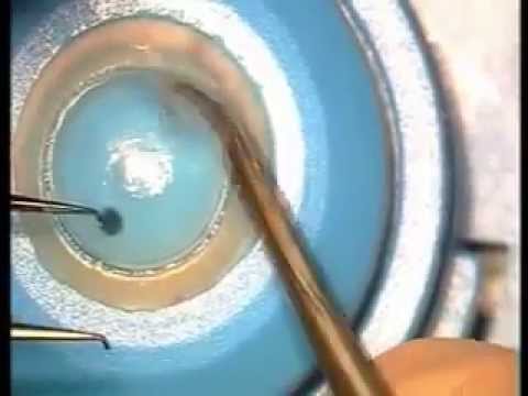 Видео Фемтосекундная кератопластика