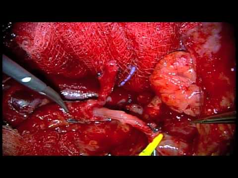 Anastomosis - Microvascular anastomosis of radial forearm free flap by Jason H. Kim MD FACS Northern California Kaiser Permanente.