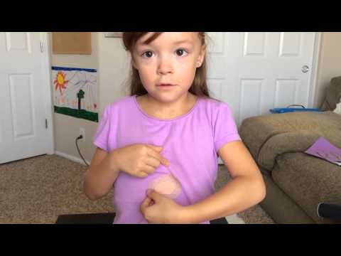 how to patch amblyopia