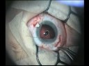 Big subluxation of lens in young children Big subluxation of lens in young children