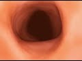 Pill Cam