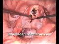 laparoscopic polymyomectomy laparoscopic polymyomectomy