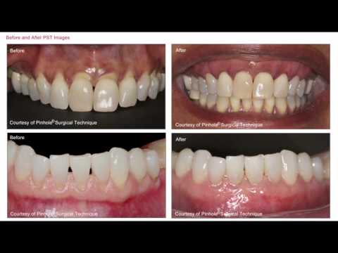 Introducing the Revolutionary Pinhole Technique: Gum Surgery with No Cuts & No Stitches