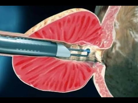 Видео: Удаление простаты последствия для мужского здоровья