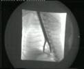 oesophageal fb removal 1
