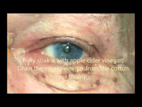 how to remove skin tags at home with vinegar