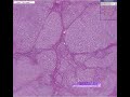 Histopathology Liver--Alpha-1-antitrypsin deficiency