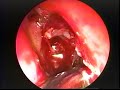 Maxillary Sinus Mucocoele Hawke MD Maxillary Sinus Mucocoele Hawke MD