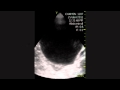 Distended Bladder