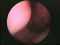 Pólipo antrocoanal de Killian Pólipo antrocoanal de Killian