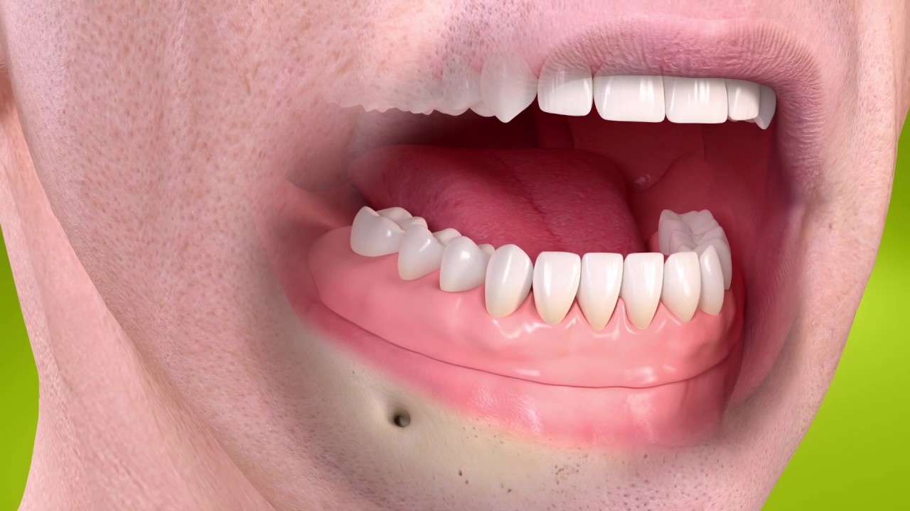 השתלת שיניים ביום אחד | STRAUMANN | ד"ר אריאל שוורץ