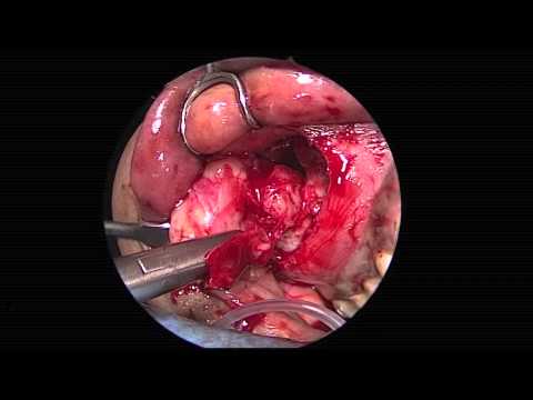 how to relieve maxillary sinus pain