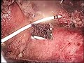 Laparoscopic Ureterolithotomy