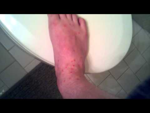 how to treat jigger infestation