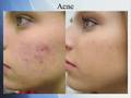 Laser Acne Treatment