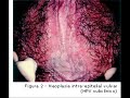 HPV