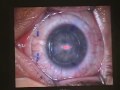 Opération de la myopie Docteur Chemla au Centre Vision Laser Paris Ouest