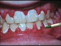 Fry Orthodontic Specialists: Brushing with Braces