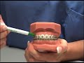 Fry Orthodontic Specialists: Brushing with Braces