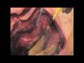 Dr  James Wittig  Total Scapula Resection  Part 3 