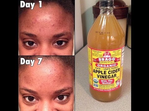 how to apple cider vinegar acne