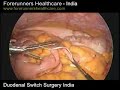 Weight loss with low cost duodenal switch surgery in India.  Sleep Apnea Nutrition