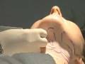 Actual Neck Liposuction Procedure