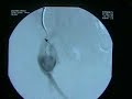 Pulsatile groin mass. Looks like It\ Pulsatile groin mass. Looks like It\