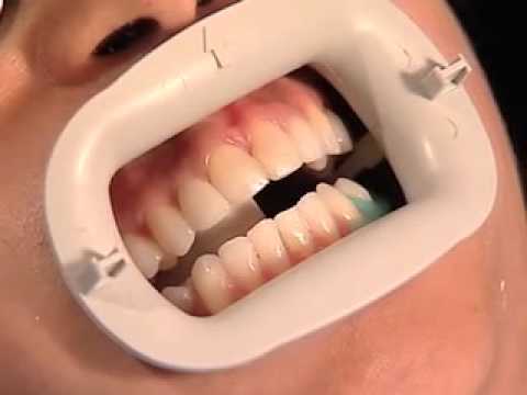 how to whiten veneers