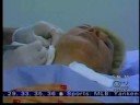 Torn Earlobe Repair; New York Plastic Surgery, Dr. Antell