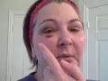 FAT GRAFTING DALLAS:  DEBBIE\