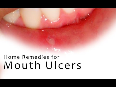 how to cure a n ulcer on your tongue