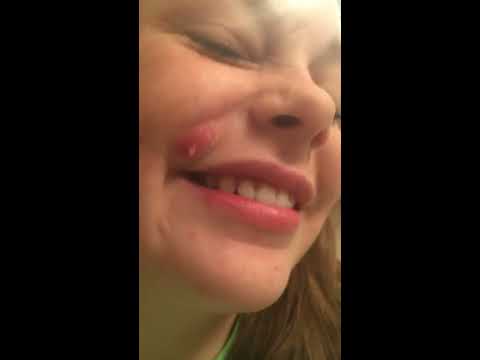 how to drain pimple