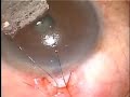 Trabeculectomy Right Eye