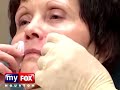ArteFill® Wrinkle Treatment by Dr. Perlman, Plastic Surgeon