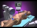 NuVasive XLIF - Minimally Invasive Spine Surgery - Dr. Bashir